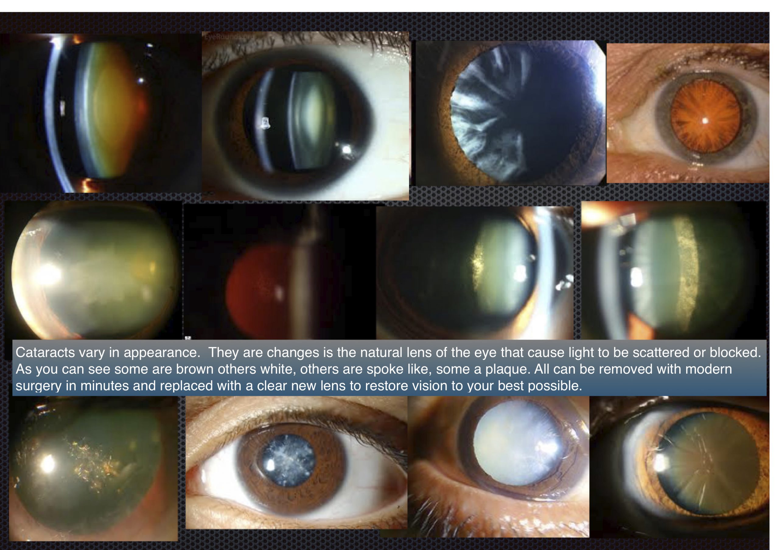 What are cataracts? Dr Ray Radford